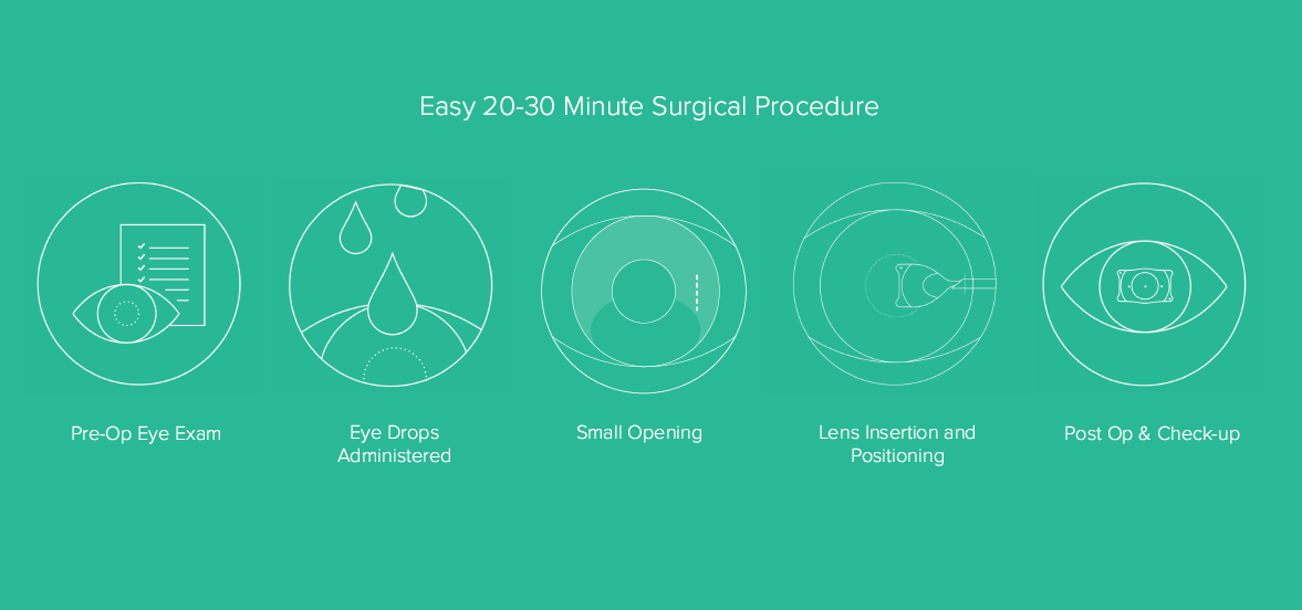 Steps for EVO Visian ICL Procedure